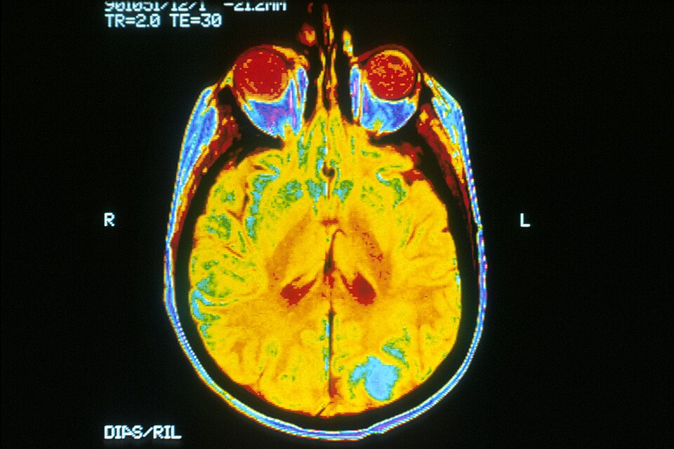 Axial MRI of the brain